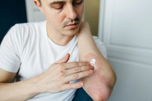 Viêm da cơ địa dùng thuốc như thế nào?