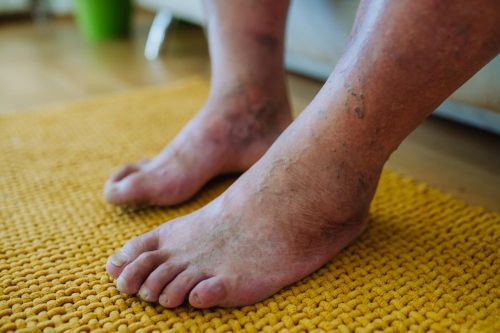 Một bệnh thường gặp ở người già đang trẻ hóa tại Việt Nam