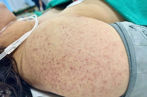 Căng thẳng ca đỡ sinh cho thai phụ sốt xuất huyết bất ngờ chuyển dạ