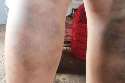 Đình chỉ cô giáo ở Quảng Nam đánh học sinh bầm tím hai chân