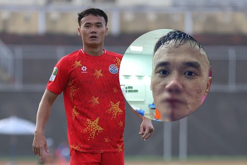 Tiền đạo từng lên tuyển Việt Nam bị đối thủ đấm vỡ mũi