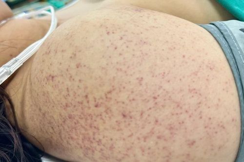 Mổ cấp cứu thai phụ mắc sốt xuất huyết nguy kịch, bé trai chào đời an toàn