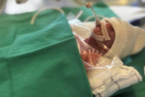 Chỉ có 1% cơ hội sống, em bé nặng 260 gram đã khỏe mạnh và được về nhà
