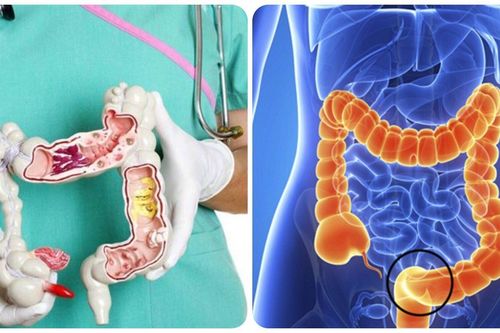 Bị ung thư đại tràng sống được bao lâu?