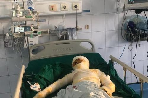 MS 967: Thảm cảnh của 3 mẹ con cùng điều trị bỏng sau vụ hỏa hoạn, kinh tế cạn kiệt cần cộng đồng giúp đỡ