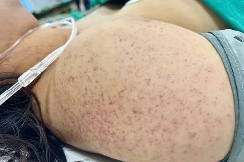 Mổ cấp cứu thai phụ mắc sốt xuất huyết nguy kịch
