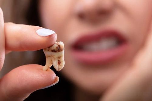 Những món ăn có thể gây sâu răng