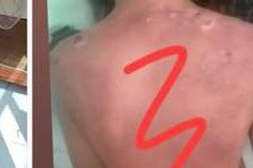 Vĩnh Phúc: Công an điều tra vụ bé trai bị bỏng nặng nghi do mẹ kế dội nước sôi