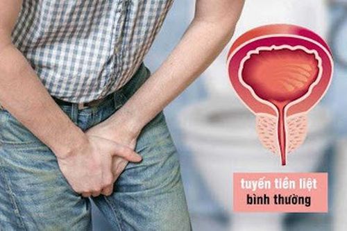 3 điều cần biết về bệnh phì đại tuyến tiền liệt