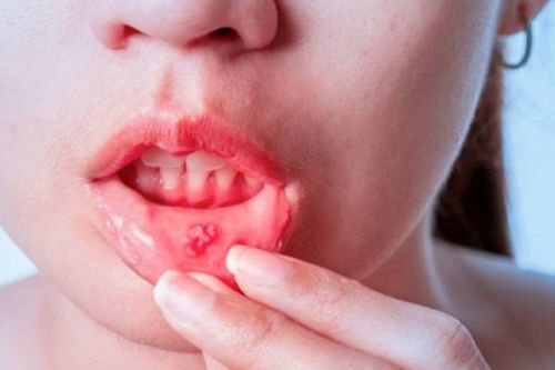 Dấu hiệu cảnh báo ung thư miệng, bạn không nên bỏ qua