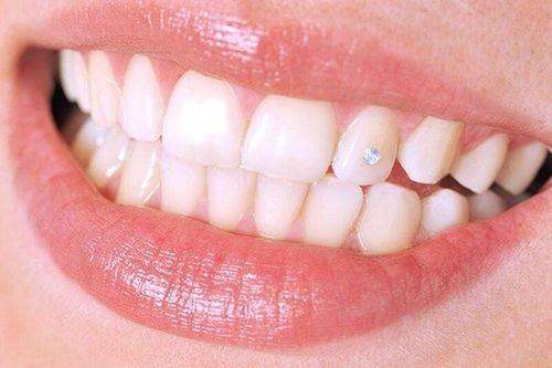 Thực hiện phục hình răng bằng cách trồng răng implant có đau không