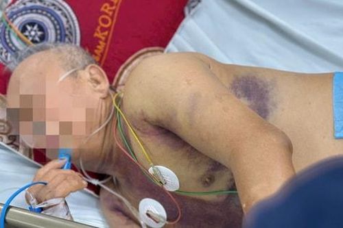 Mất nửa lượng máu trong cơ thể, nguy kịch vì sốt xuất huyết