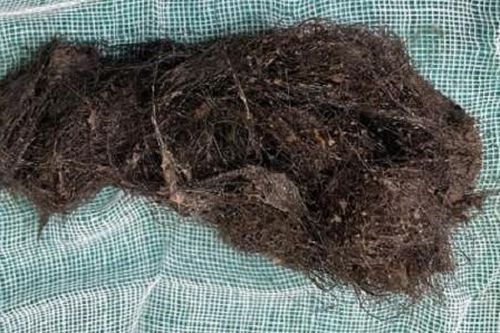 Bé gái ở Vĩnh Long nuốt tóc vào bụng suốt thời gian dài