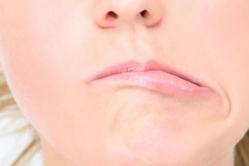 Người phụ nữ bị liệt mặt vì thói quen phổ biến nhiều người mắc phải