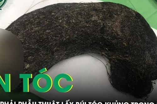 Sau 8 năm ăn tóc bé gái phải nhập viện cấp cứu