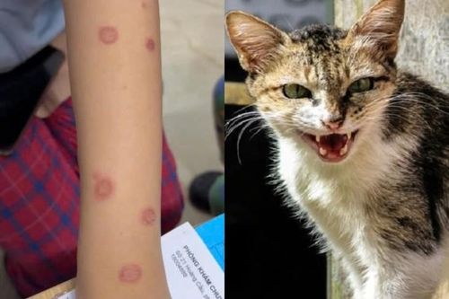 Cả gia đình nhiễm nấm da lây từ mèo hoang, bác sĩ cảnh báo