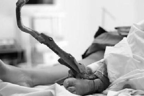 Người phụ nữ bị chân chống xe máy đâm xuyên cẳng chân