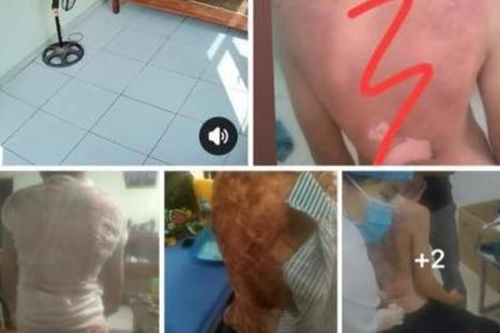 Công an vào cuộc điều tra vụ bé trai bị bỏng nặng do mẹ kế dội nước sôi