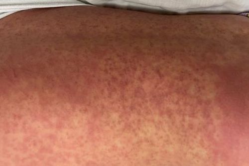 Bé gái nổi ban toàn thân, không ngờ mắc bệnh hiếm rất khó phát hiện