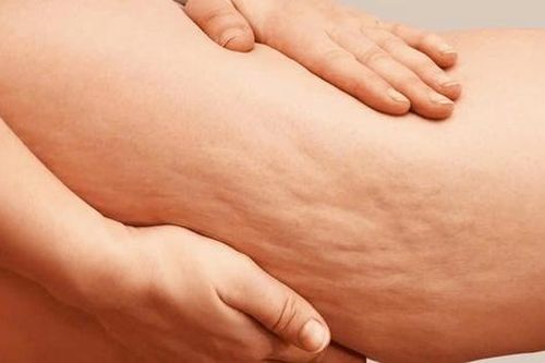 Đối phó với da sần vỏ cam