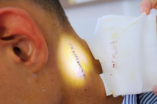 Nam thanh niên phải cấp cứu vì chủ quan với nốt mụn ở cổ