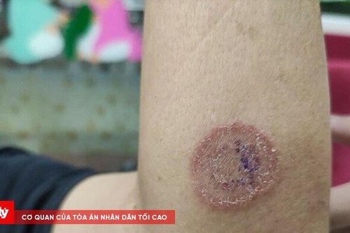 Hà Nội: Cả nhà bị nhiễm nấm từ mèo