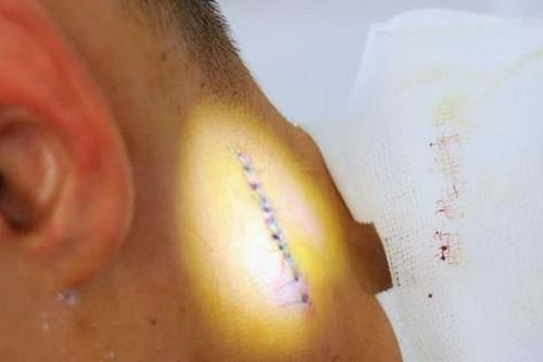 Nam sinh 16 tuổi phải nhập viện vì chủ quan với nốt mụn ở cổ