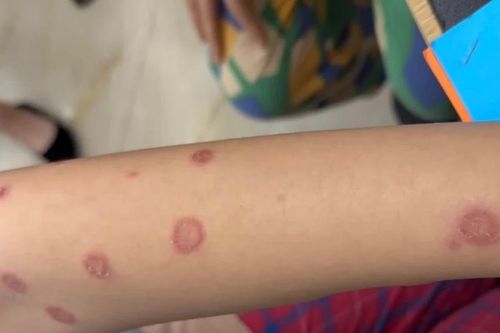 Nhận nuôi mèo hoang, cả gia đình bị nhiễm nấm da