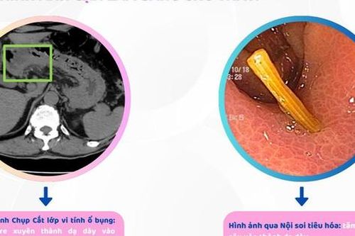 Người đàn ông ở Hải Phòng bị thủng dạ dày, thừa nhận một sai lầm mà nhiều người Việt mắc phải