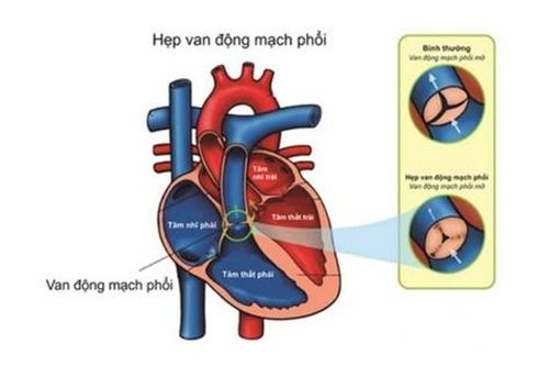 Thuốc nào điều trị hẹp van động mạch phổi?