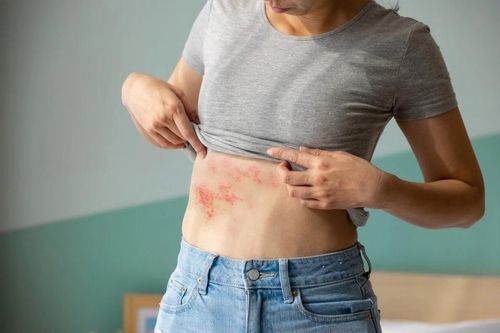 Điều nguy hiểm nhất sau khi mắc thủy đậu