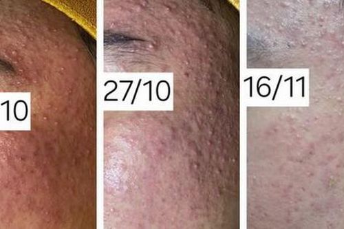 Thanh niên 16 tuổi ở Phú Thọ nhập viện mặt sưng phù do sai lầm khi chăm sóc da nhiều bạn trẻ Việt mắc phải