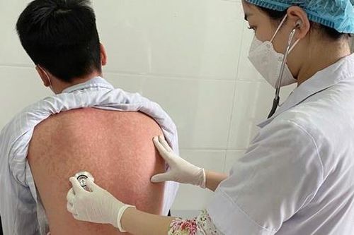 Người lớn chủ quan với bệnh sởi dễ gặp nhiều biến chứng