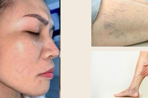 Giãn mao mạch gây mất thẩm mỹ, có cách nào khắc phục?