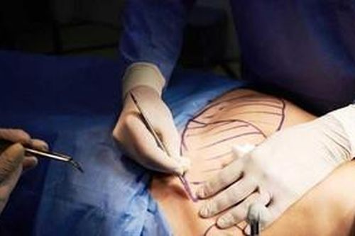 Hơn trăm ngày đau đớn sau khi hút mỡ bụng gặp biến chứng nặng nề