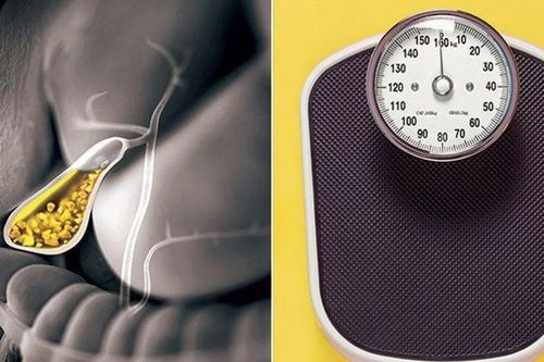 Nhịn ăn gián đoạn có thể làm tăng nguy cơ mắc sỏi túi mật