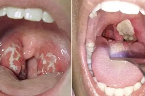 Bệnh nhân tử vong do bệnh bạch hầu tại Cao Bằng