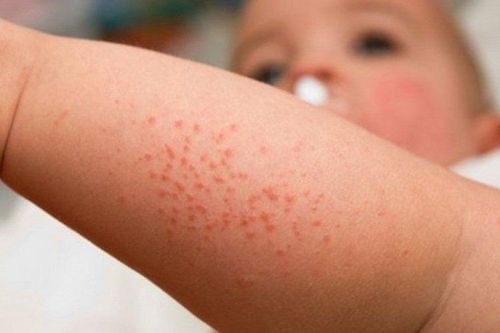 Cách phòng bệnh sốt xuất huyết đơn giản, hiệu quả