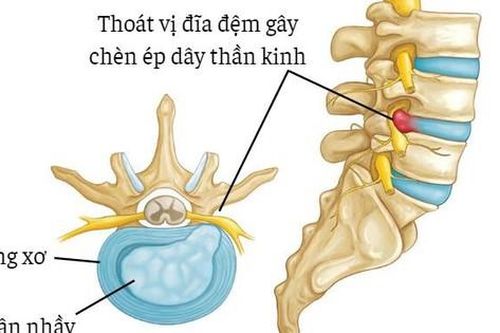 Đau lưng dưới do ngồi nhiều làm sao phòng tránh?