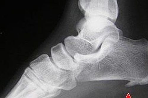 Các phương pháp điều trị gai xương và chăm sóc tại nhà