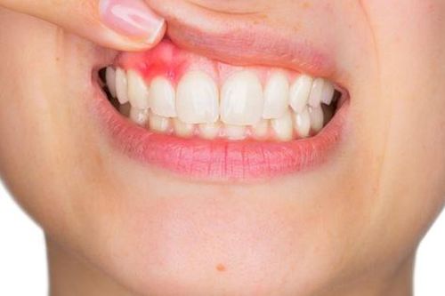 4 biến chứng khi bị viêm lợi trùm
