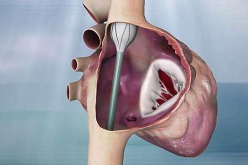 Van tim nhân tạo thế hệ mới