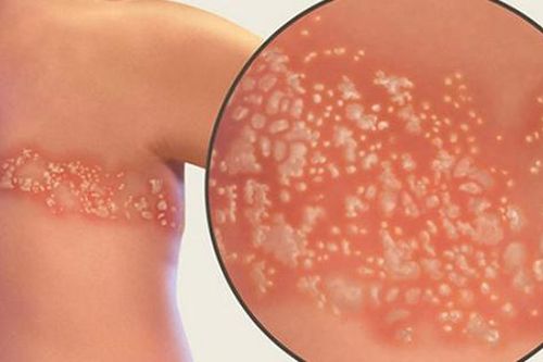 Mẹo diệt con giời leo bằng phương pháp tự nhiên