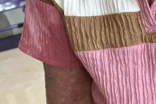 Bé gái 12 tuổi làm mất vé số bị 'mẹ nuôi' nhẫn tâm tạt nước sôi gây bỏng nặng