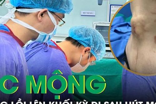 Ác mộng sống 7 tháng với khối kỳ dị lồi lên vùng bụng sau hút mỡ