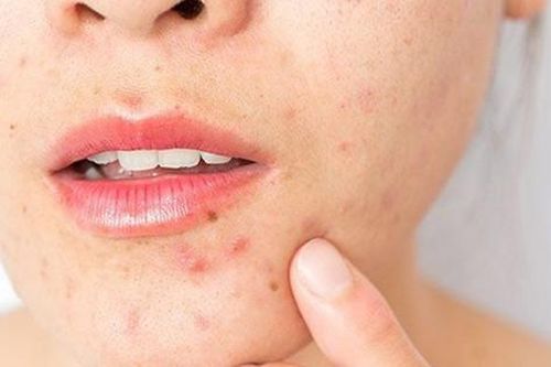10 nguyên nhân gây mụn trứng cá ở người lớn và cách xử trí