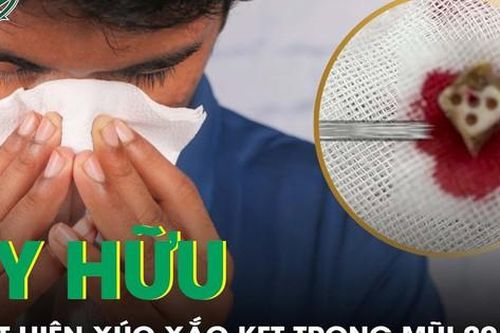 Nghẹt mũi kéo dài, đi khám phát hiện xúc xắc kẹt trong mũi 20 năm