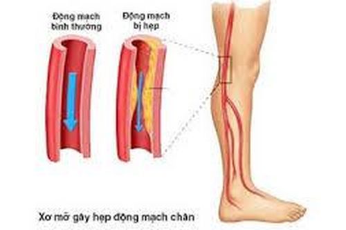 Phòng ngừa và điều trị bệnh hẹp động mạch chi dưới như thế nào?