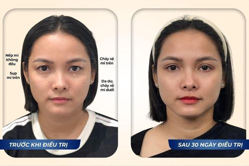 Cắt mí bao nhiêu tiền? Khám phá chi phí và lợi ích khi thực hiện tại Dr. Eye