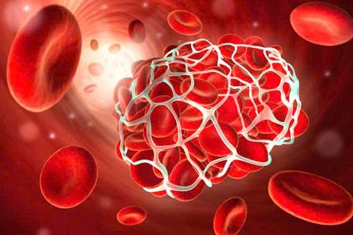 Tập luyện đúng cách ở người mắc hội chứng antiphospholipid